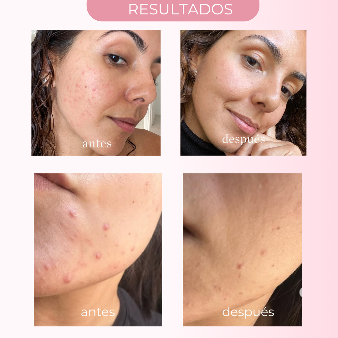 SOS SUSPENSIÓN SECANTE 0 ACNÉ