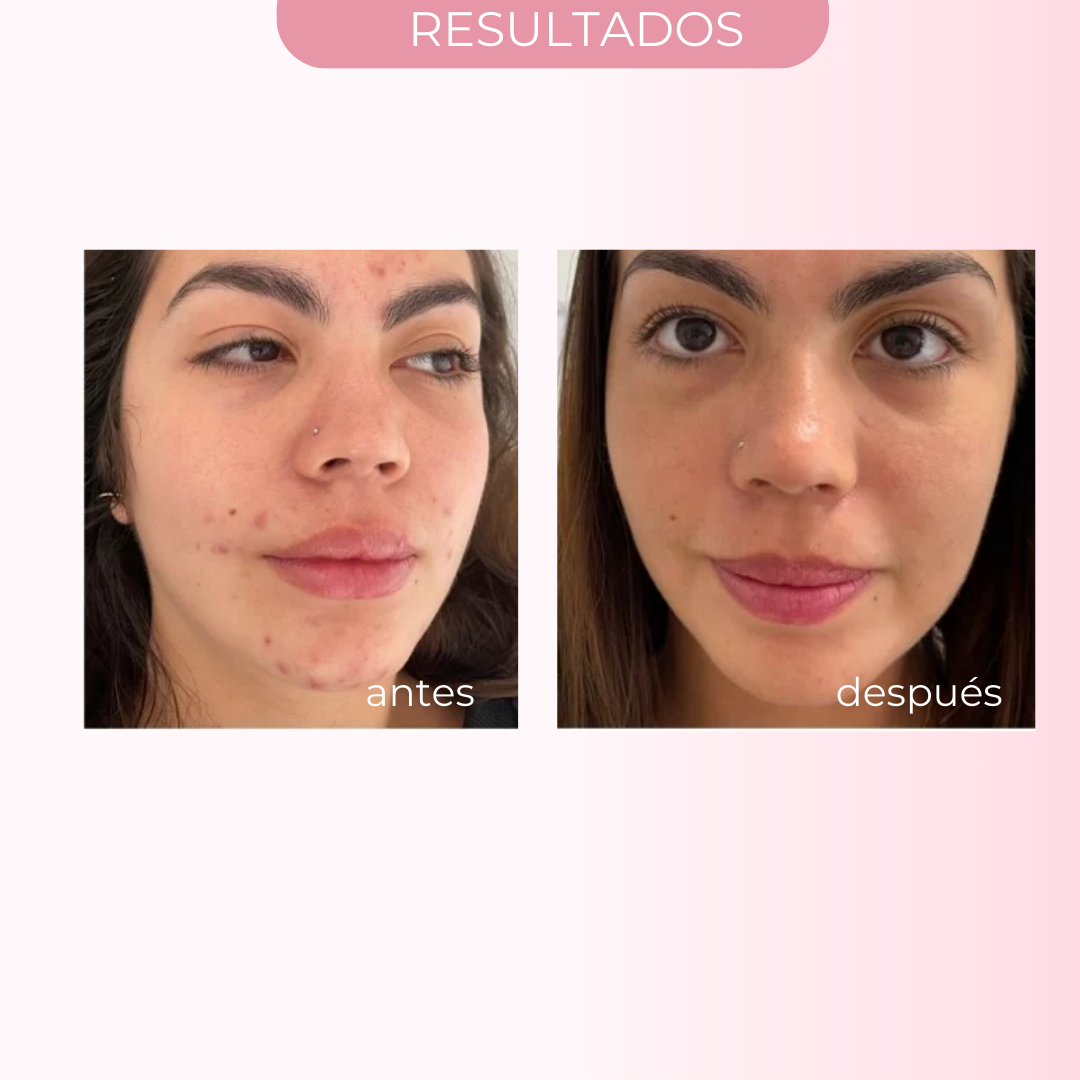 SOS SUSPENSIÓN SECANTE 0 ACNÉ